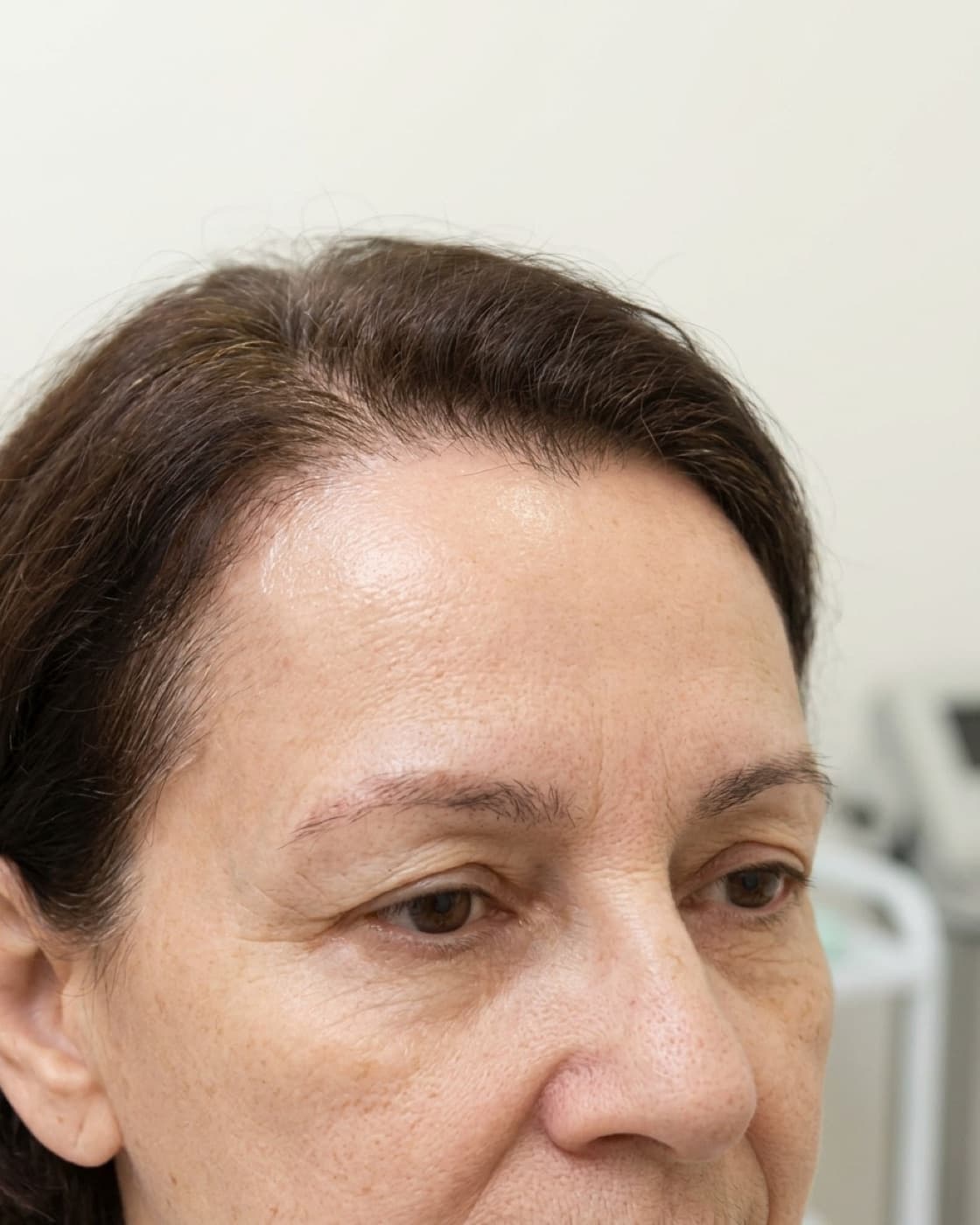 Mulher com recuo da linha de implantação do cabelo na testa