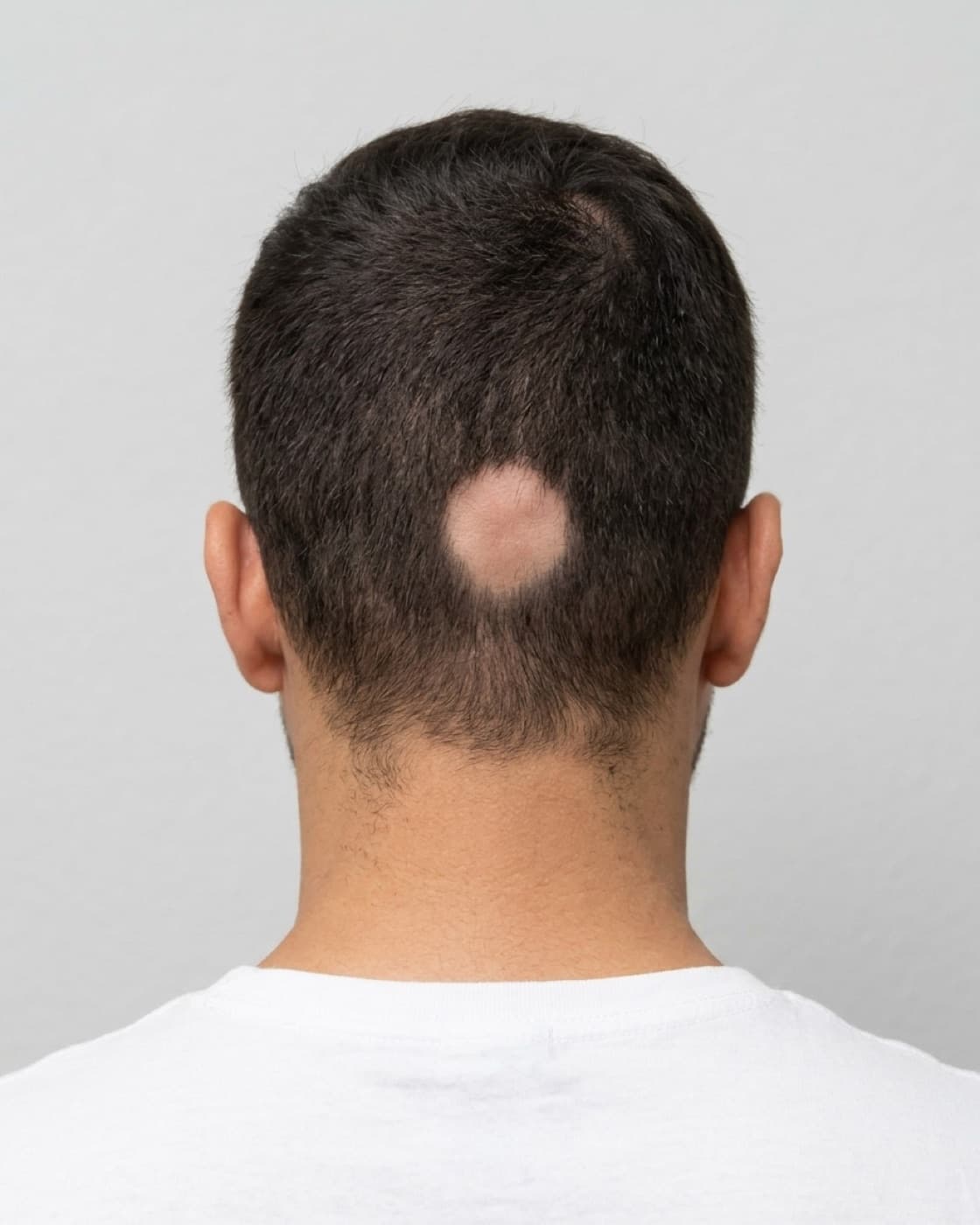 Parte de trás da cabeça com uma placa arredondada e lisa, sem cabelo