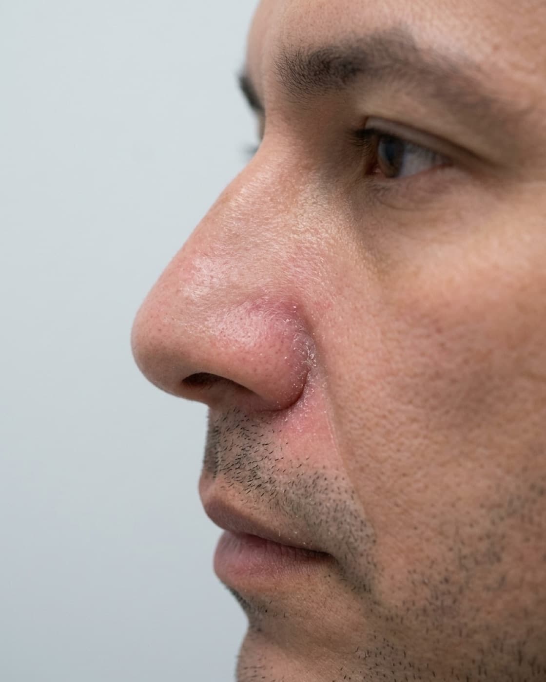 Homem de perfil com vermelhidão e descamação fina na lateral do nariz