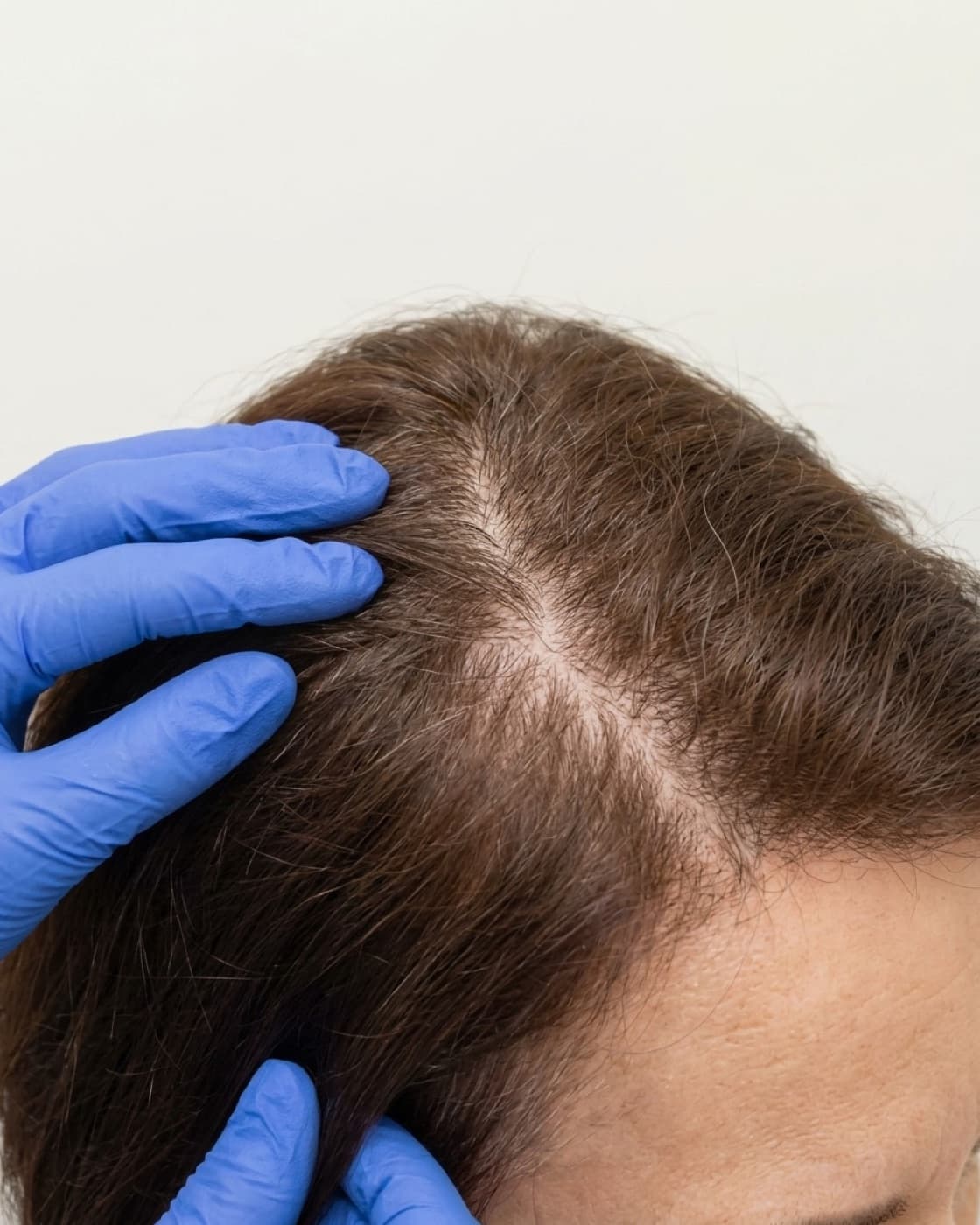 Dermatologista examina o couro cabeludo de uma mulher com afinamento difuso dos fios