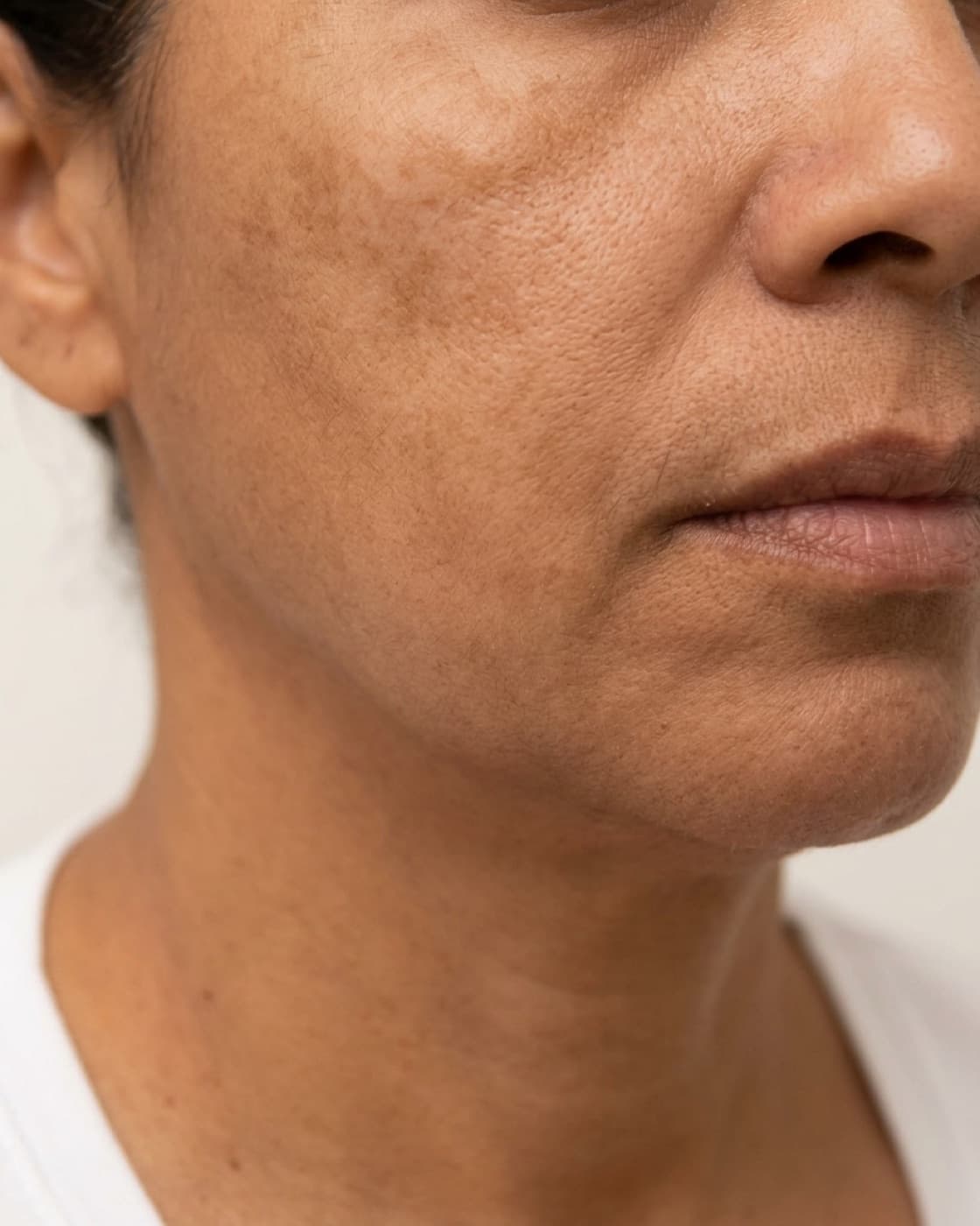 Rosto de mulher com manchas acastanhadas de melasma nas maçãs do rosto