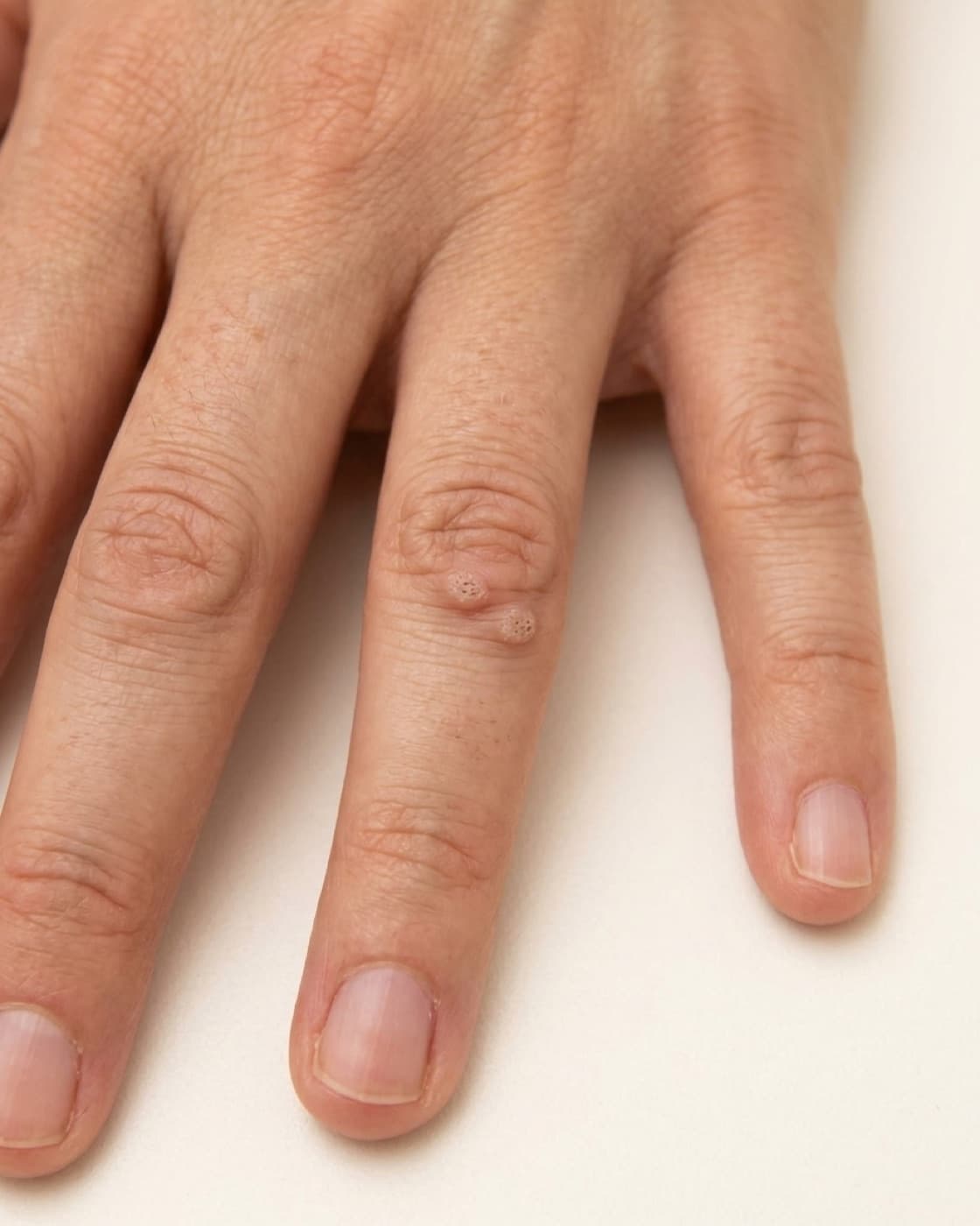 Dedos da mão com pequenas verrugas de superfície áspera