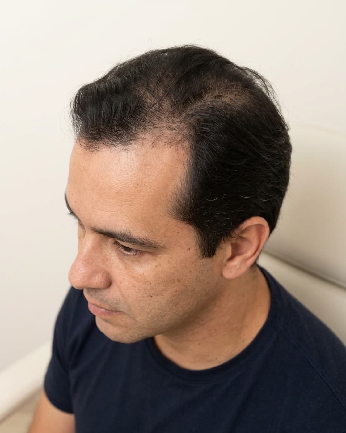 Homem com entradas e afinamento dos fios no topo da cabeça