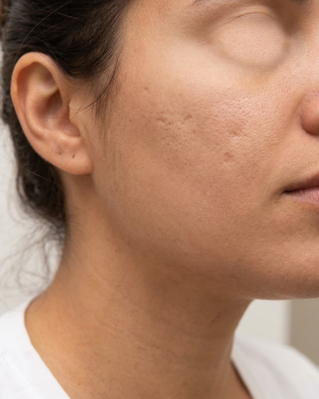 Bochecha com cicatrizes de acne deprimidas