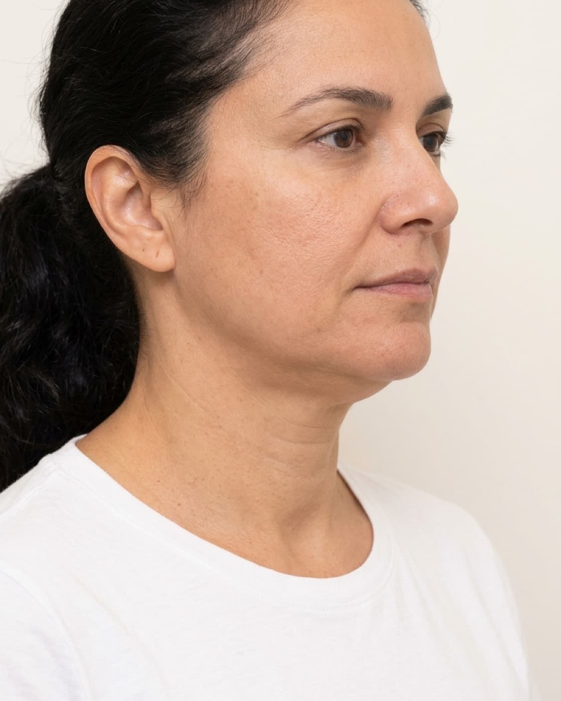Mulher de perfil com perda de definição do contorno da mandíbula e papada