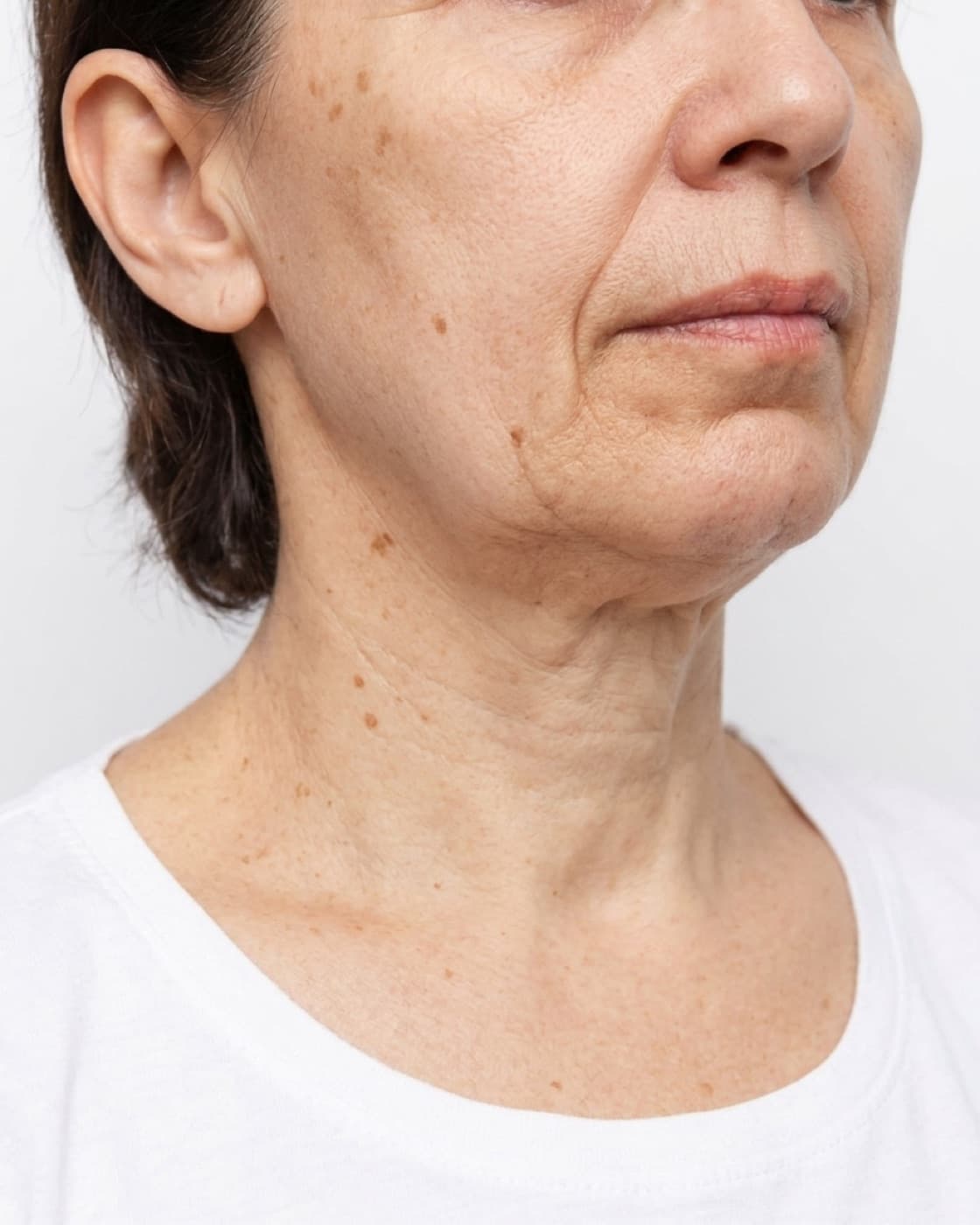 Mulher madura com flacidez no rosto, sulcos marcados e perda de definição da mandíbula