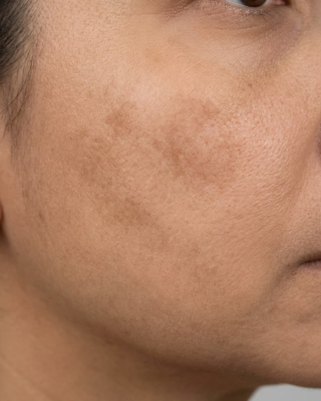 Rosto com manchas acastanhadas de melasma na maçã do rosto