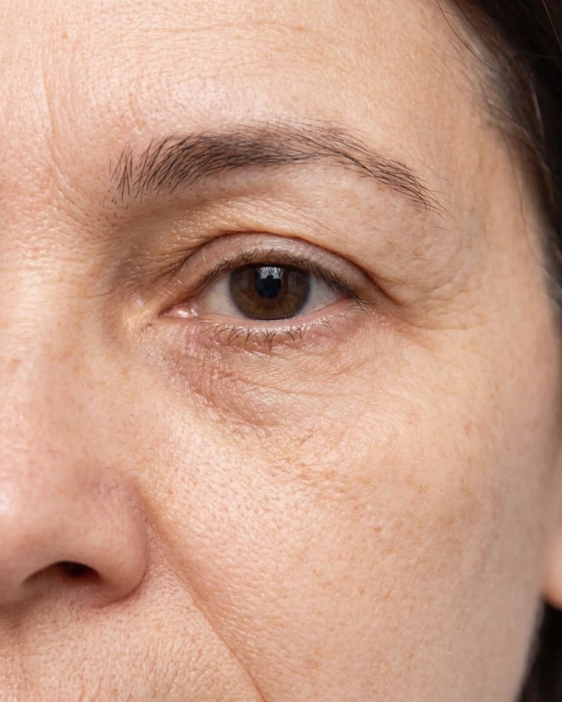 Região dos olhos de uma mulher com olheiras e leve depressão abaixo dos olhos