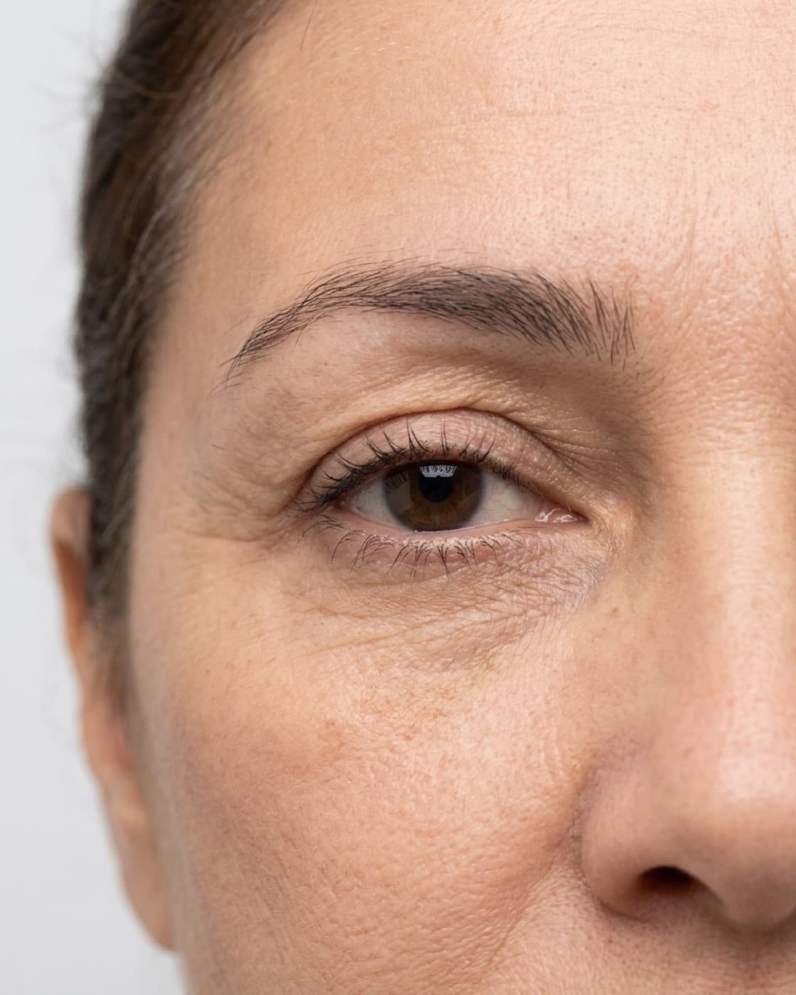 Região dos olhos de uma mulher madura com excesso de pele nas pálpebras