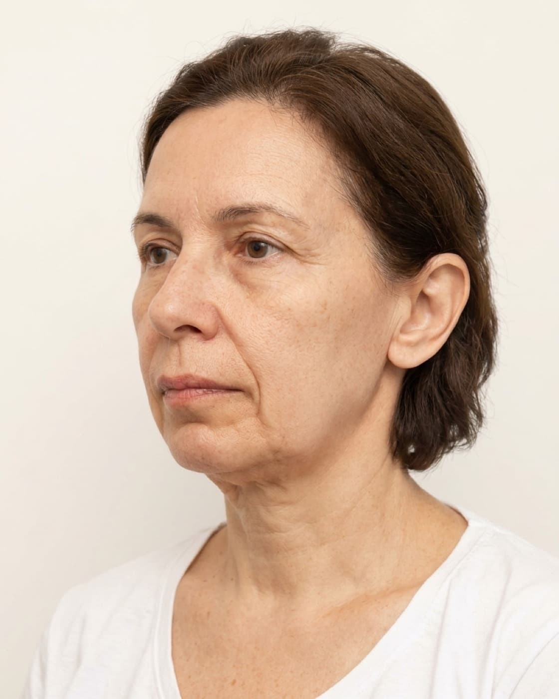 Mulher madura com perda de volume no rosto e sulcos marcados