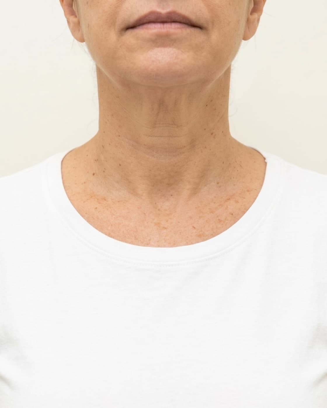 Pescoço e colo de uma mulher madura com linhas e flacidez leve