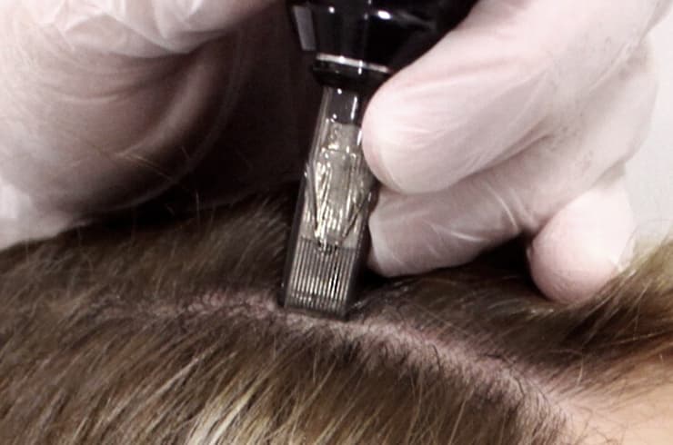 Aplicação de MMP no couro cabeludo com aparelho de microagulhas, com o cabelo separado em mechas